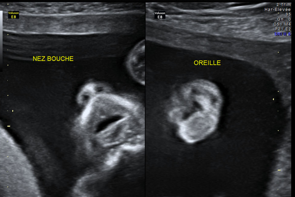 Echographies du 2e trimestre